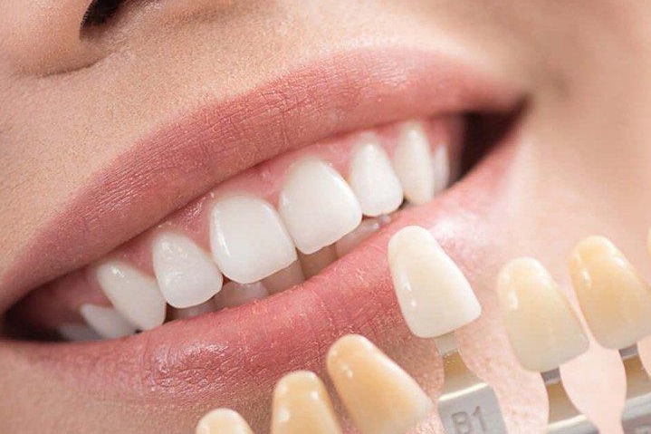 Виниры – особенности Виниры – особенности