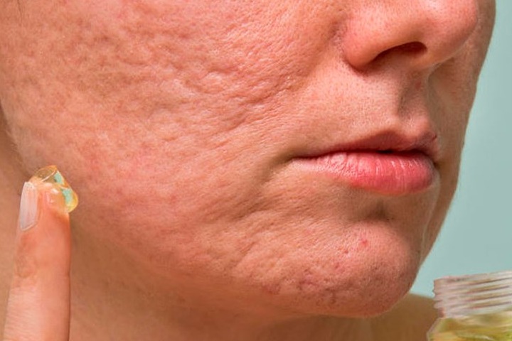 Как избавиться от шрамов и рубцов