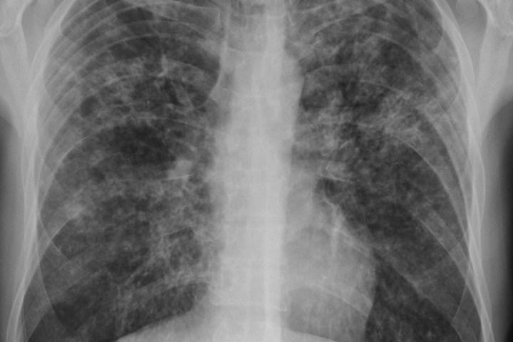 Больных туберкулезом кузбассовцев заставили лечиться