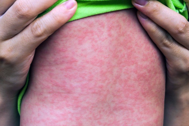 Число заболевших корью в Новосибирске выросло