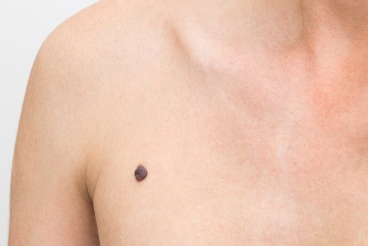 Меланома - симптомы, причины, лечение и профилактика Меланома - симптомы, причины, лечение и профилактика