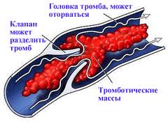 Причины и лечение тромбофлебита 