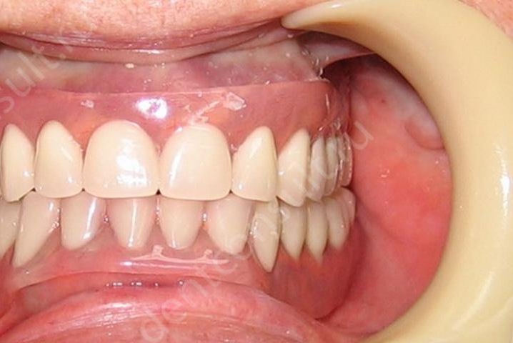 Какие съемные протезы бывают и насколько они удобны в использовании? Какие съемные протезы бывают и насколько они удобны в использовании?