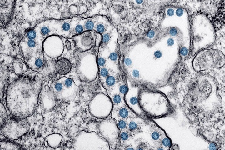 Первый пациент с коронавирусом умер в Красноярске. Он мог заразиться в краевом глазном центре