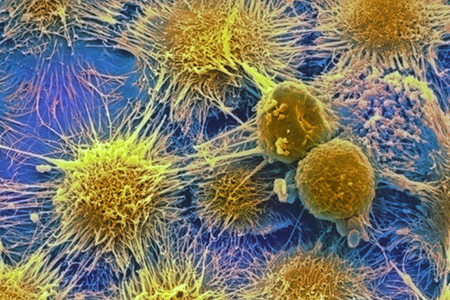 Сибирские ученые разработали новый способ диагностики и лечения рака Сибирские ученые разработали новый способ диагностики и лечения рака