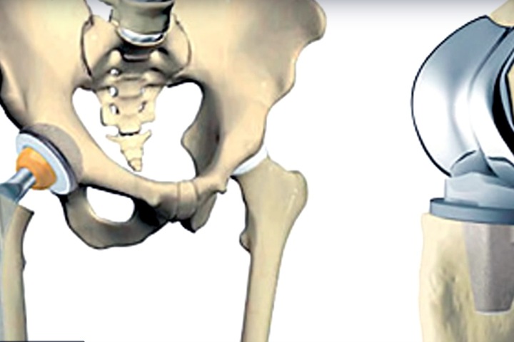 Росздравнадзор отозвал лицензии на инновационные новосибирские эндопротезы