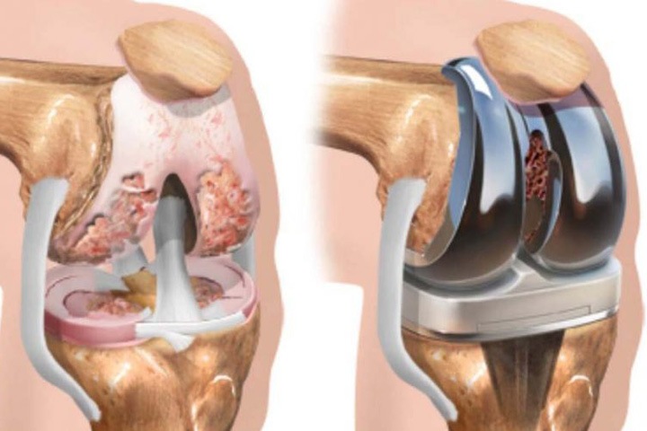 Глава НИИТО рассказал об отсутствии соглашений с конкурентами новосибирских разработчиков эндопротезов Глава НИИТО рассказал об отсутствии соглашений с конкурентами новосибирских разработчиков эндопротезов