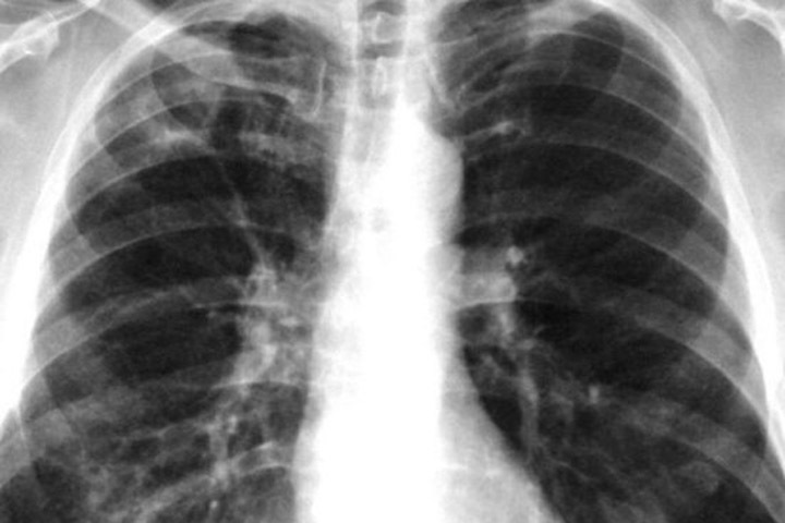 Алтайский депутат предрекает эпидемию туберкулеза в Рубцовске Алтайский депутат предрекает эпидемию туберкулеза в Рубцовске