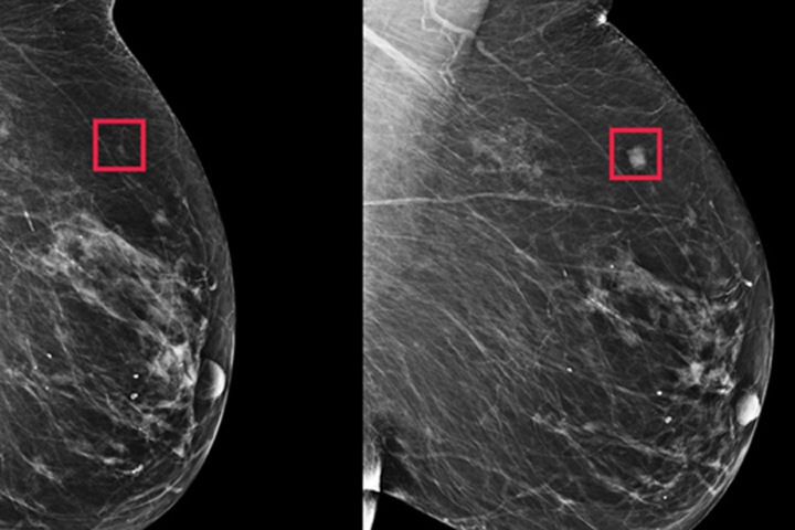 Какие лабораторные тесты расскажут о риске рака молочной железы Какие лабораторные тесты расскажут о риске рака молочной железы