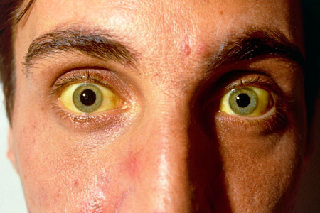 Новосибирцы в два раза чаще болеют гепатитом, чем в среднем по стране Новосибирцы в два раза чаще болеют гепатитом, чем в среднем по стране