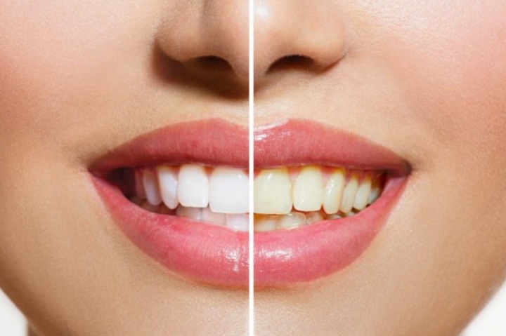 7 продуктов Prozac для белоснежной улыбки