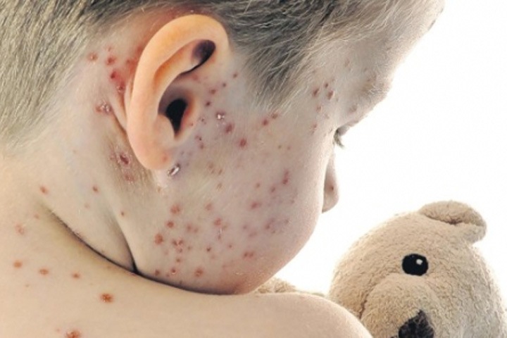 Карантин из-за кори введен в 13 учебных заведениях Новосибирска