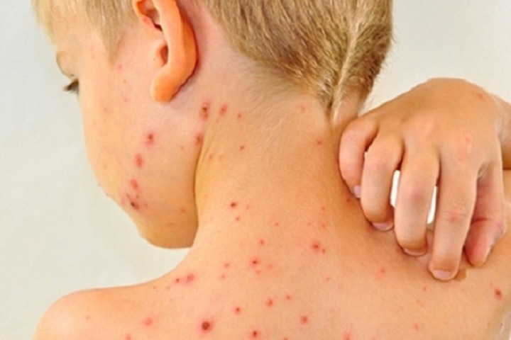 Новосибирск экстренно вакцинируют от кори Новосибирск экстренно вакцинируют от кори