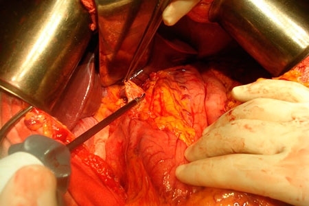 Новосибирские хирурги впервые за Уралом вырезали часть печени, не вынимая ее из пациента Новосибирские хирурги впервые за Уралом вырезали часть печени, не вынимая ее из пациента