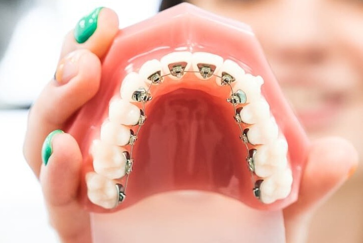 Особенности брекетов Win Особенности брекетов Win