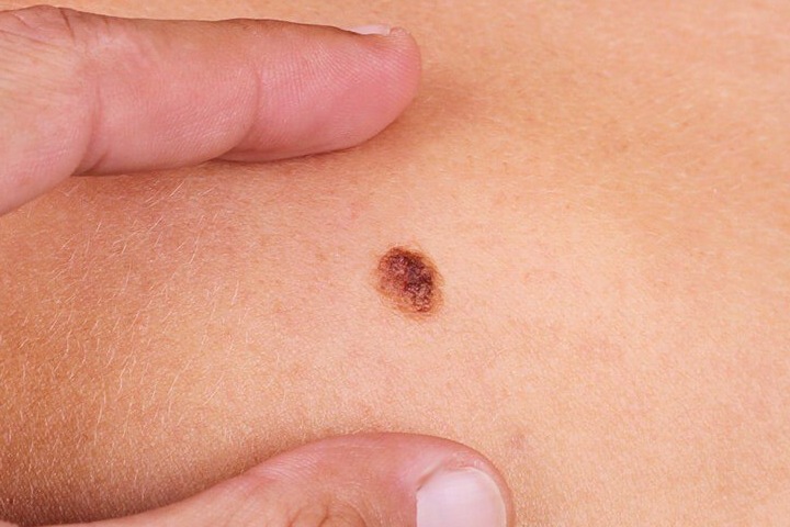 Саркома, основные виды, симптомы заболевания