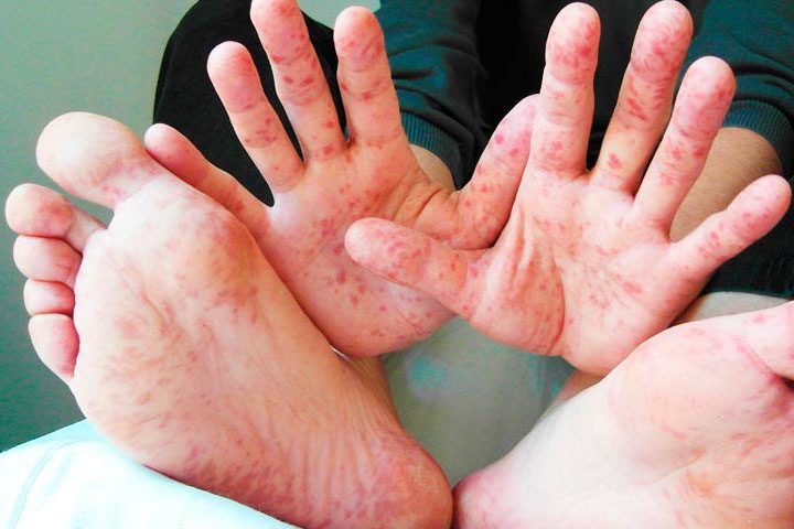 Новосибирский минздрав отчитался о ликвидации очага кори Новосибирский минздрав отчитался о ликвидации очага кори