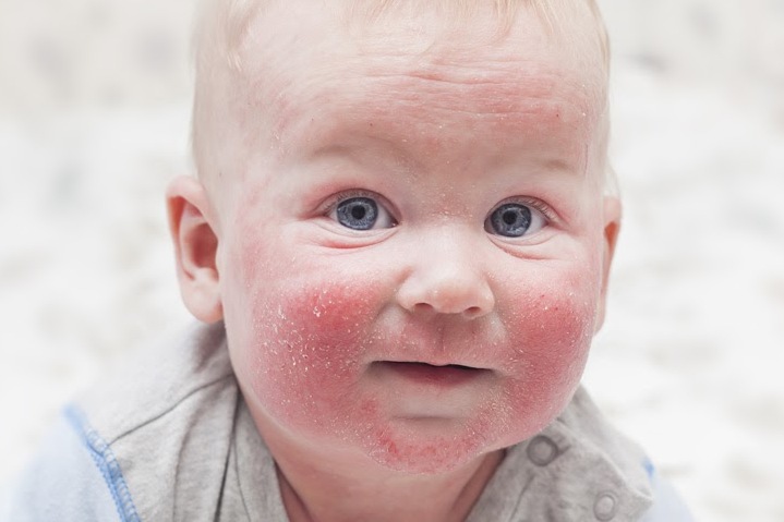 Атопический дерматит у детей