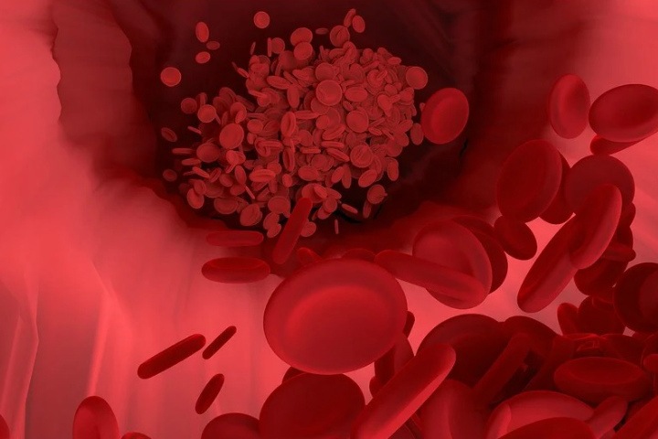 Сибирские ученые предложили использовать при лечении коронавируса препарат-тромболитик