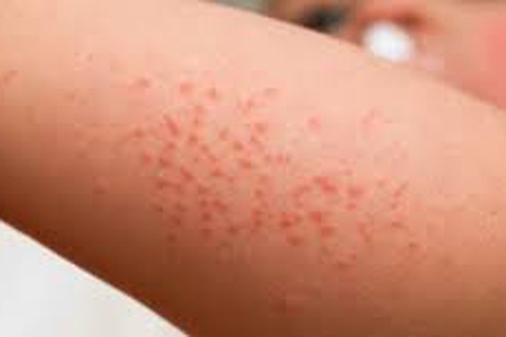 Вспышка кори произошла в кампусе НГУ