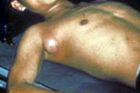 Ребенок с бубонной чумой госпитализирован на Алтае Ребенок с бубонной чумой госпитализирован на Алтае