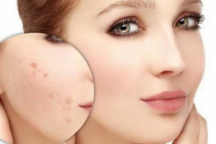 Как избавиться от постакне — подробная инструкция Как избавиться от постакне — подробная инструкция