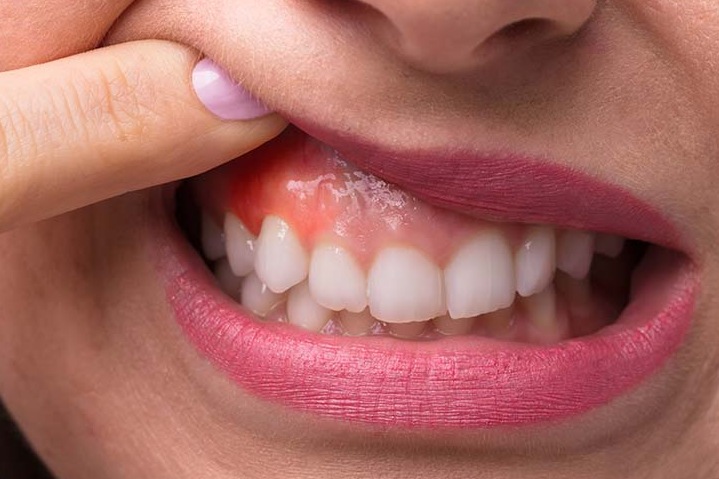 Распространенные заболевания десен: основные симптомы и лечение Распространенные заболевания десен: основные симптомы и лечение