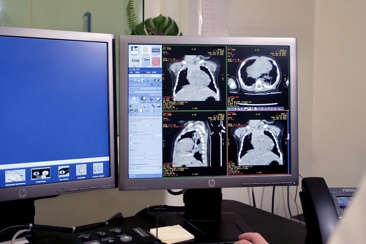 Поражение легких у новосибирских детей с ковидом достигает 80%