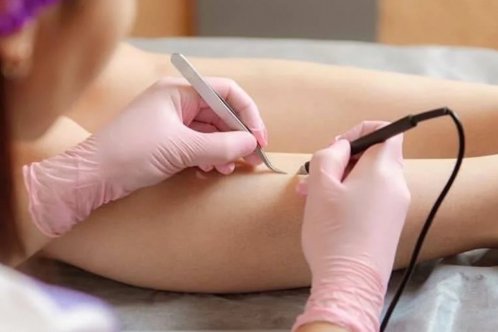 Лазерная эпиляция или электроэпиляция – что выбрать в Днепре? Лазерная эпиляция или электроэпиляция – что выбрать в Днепре?