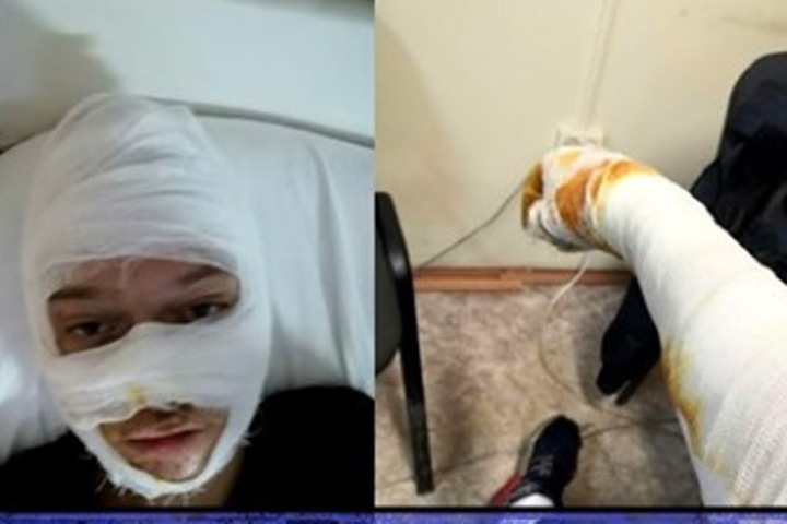 Получившие ожоги подростки рассказали о произволе полицейских в Иркутске