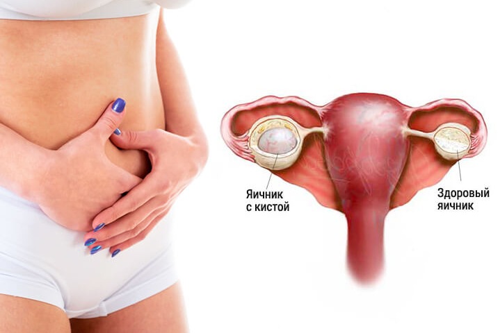 Может ли киста переродиться в рак яичника Может ли киста переродиться в рак яичника
