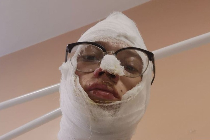 Обгоревших в машине полиции иркутских подростков обвинили в хранении наркотиков