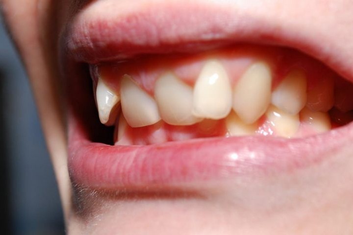 Почему нужно исправить неправильный прикус