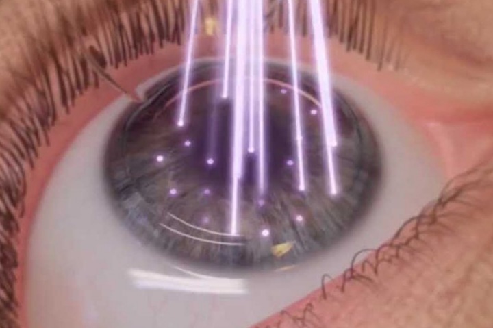 Лазерная коррекция – восстановление зрения Лазерная коррекция – восстановление зрения