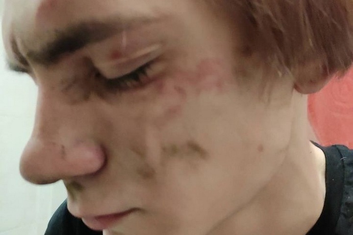 Студента журфака Новосибирского госуниверситета избили в Бердске Студента журфака Новосибирского госуниверситета избили в Бердске