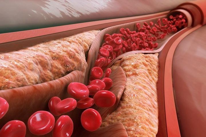 Томские ученые узнали об изменении функций клеток при развитии атеросклероза Томские ученые узнали об изменении функций клеток при развитии атеросклероза