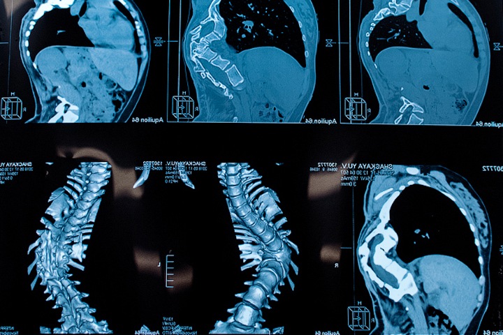 «Подходила к зеркалу и расстраивалась»: как живут со сколиозом в Сибири «Подходила к зеркалу и расстраивалась»: как живут со сколиозом в Сибири