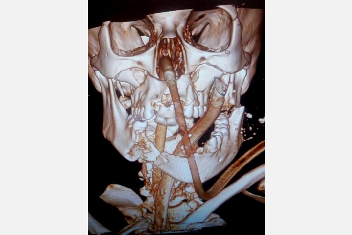 Красноярские хирурги восстановили лицо женщине с оторванными после ДТП языком и челюстью