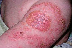 Медсестра в Томской области по ошибке ввела школьнице 10 доз вакцины против туберкулеза